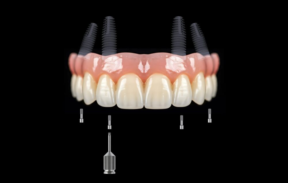 Dental Implants Hinckley